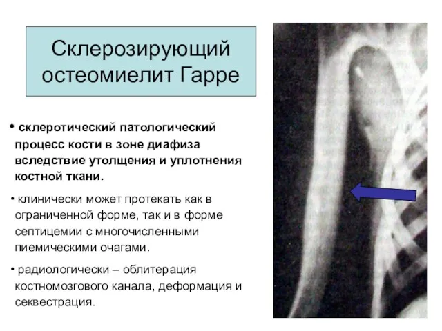склеротический патологический процесс кости в зоне диафиза вследствие утолщения и