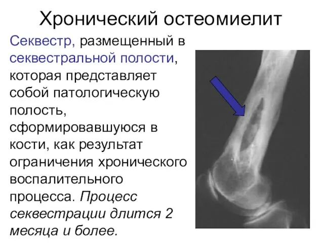 Хронический остеомиелит Секвестр, размещенный в секвестральной полости, которая представляет собой