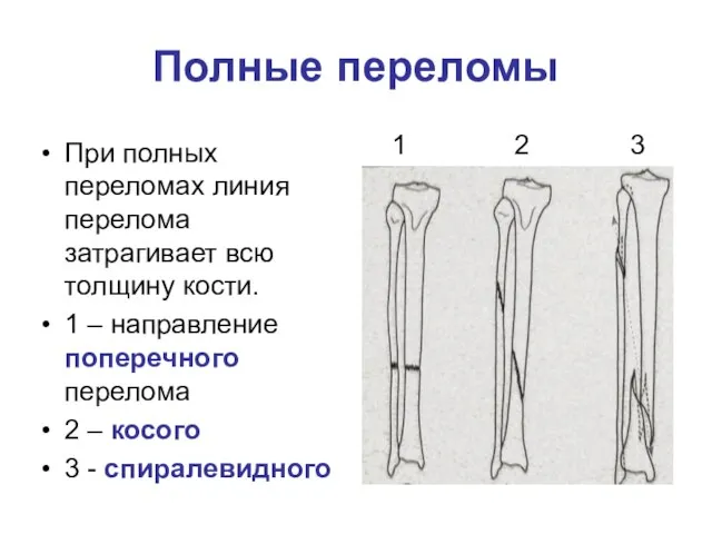 Полные переломы При полных переломах линия перелома затрагивает всю толщину