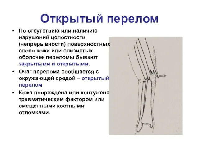 Открытый перелом По отсутствию или наличию нарушений целостности (непрерывности) поверхностных