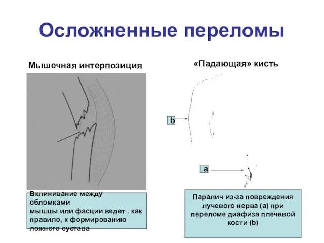 Осложненные переломы Мышечная интерпозиция Вклинивание между обломками мышцы или фасции