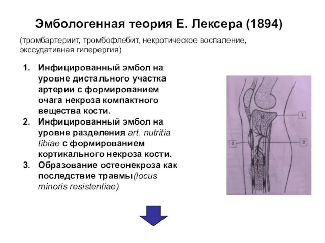 Эмбологенная теория Е. Лексера (1894) (тромбартериит, тромбофлебит, некротическое воспаление, экссудативная гиперергия) Инфицированный эмбол