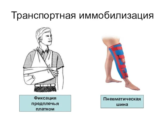 Транспортная иммобилизация Фиксация предплечья платком Пневматическая шина