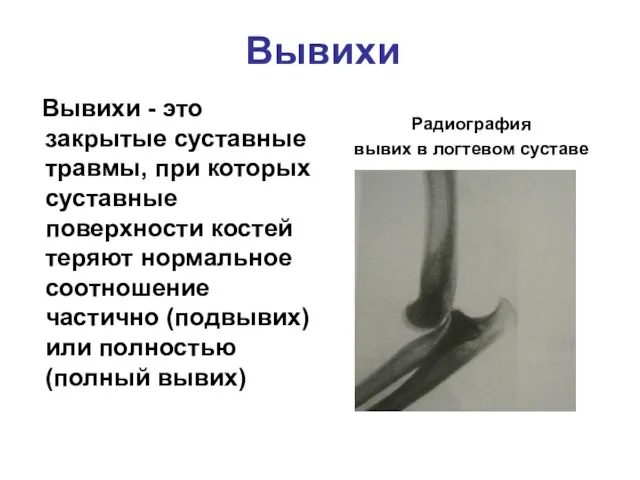 Вывихи Вывихи - это закрытые суставные травмы, при которых суставные