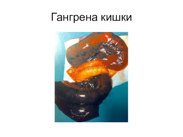 Гангрена кишки