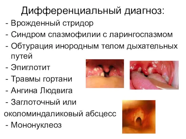 Дифференциальный диагноз: Врожденный стридор Синдром спазмофилии с ларингоспазмом Обтурация инородным телом дыхательных путей