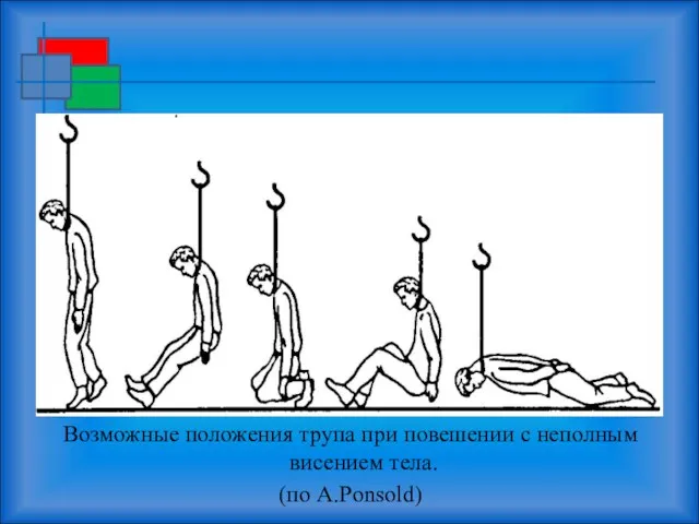 Возможные положения трупа при повешении с неполным висением тела. (по A.Ponsold)