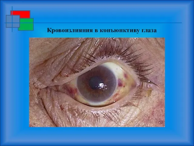 Кровоизлияния в конъюнктиву глаза
