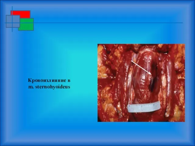 Кровоизлияние в m. sternohyoideus