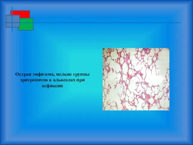 Острая эмфизема, мелкие группы эритроцитов в альвеолах при асфиксии