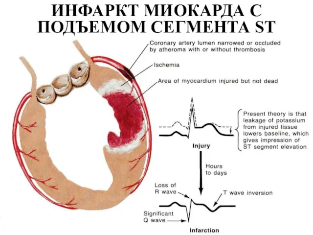 ИНФАРКТ МИОКАРДА С ПОДЪЕМОМ СЕГМЕНТА ST