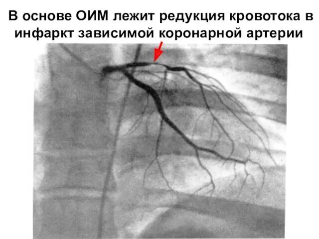 В основе ОИМ лежит редукция кровотока в инфаркт зависимой коронарной артерии