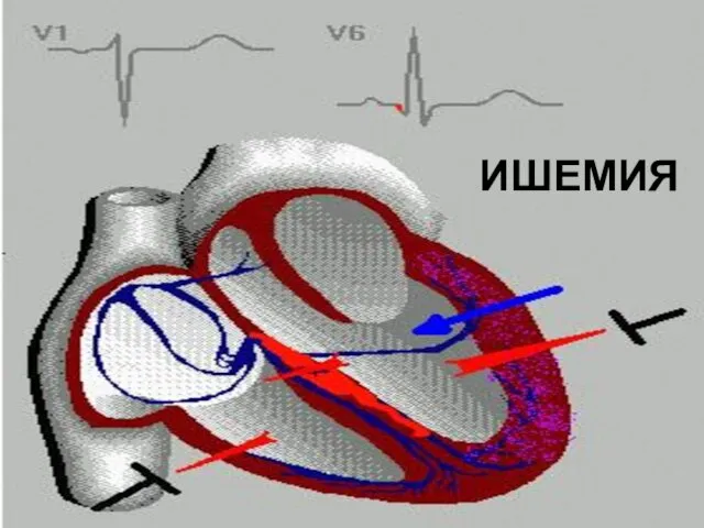 ИШЕМИЯ