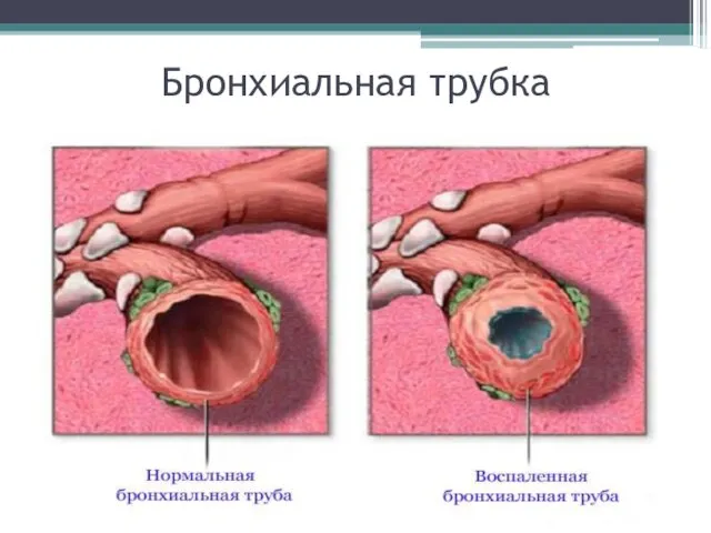 Бронхиальная трубка