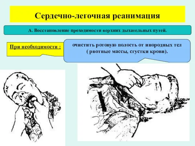 Сердечно-легочная реанимация А. Восстановление проходимости верхних дыхательных путей. При необходимости