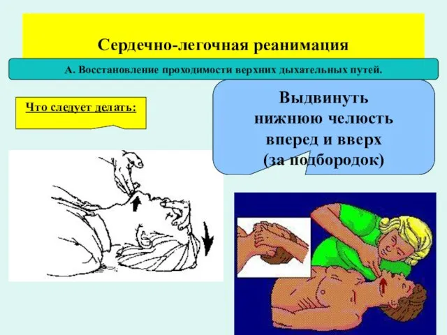 Сердечно-легочная реанимация А. Восстановление проходимости верхних дыхательных путей. Что следует