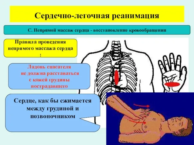 Сердечно-легочная реанимация С. Непрямой массаж сердца - восстановление кровообращения Правила