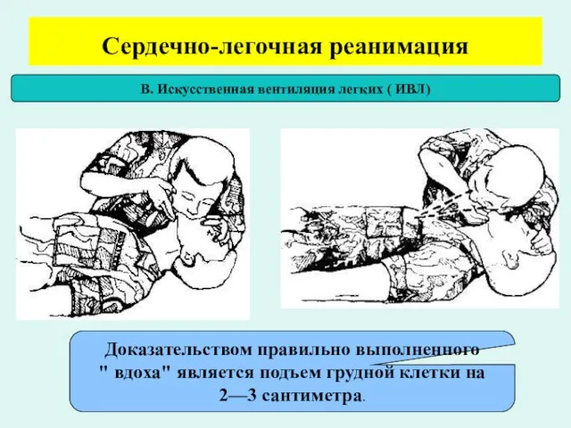 Сердечно-легочная реанимация В. Искусственная вентиляция легких ( ИВЛ) Доказательством правильно