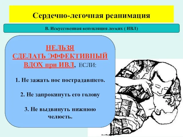 Сердечно-легочная реанимация В. Искусственная вентиляция легких ( ИВЛ) НЕЛЬЗЯ СДЕЛАТЬ