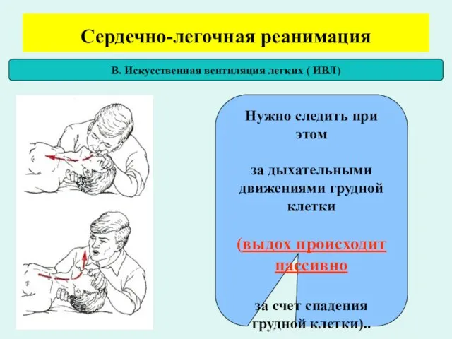 Сердечно-легочная реанимация В. Искусственная вентиляция легких ( ИВЛ) Нужно следить