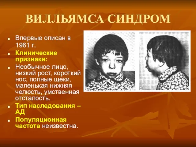 ВИЛЛЬЯМСА СИНДРОМ Впервые описан в 1961 г. Клинические признаки: Необычное