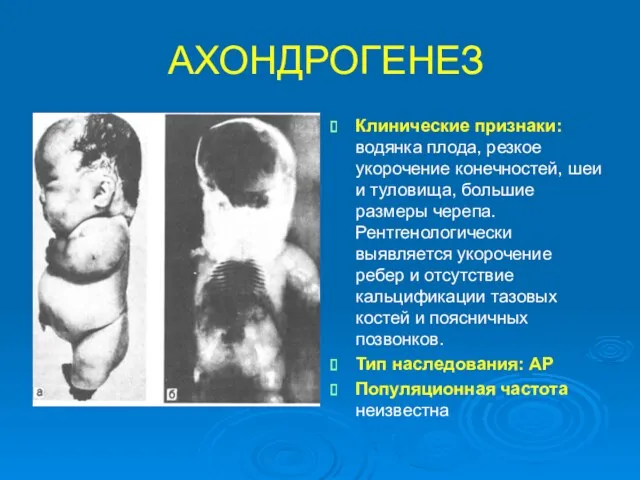 АХОНДРОГЕНЕЗ Клинические признаки: водянка плода, резкое укорочение конечностей, шеи и