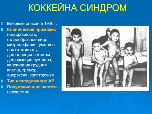 КОККЕЙНА СИНДРОМ Впервые описан в 1946 г. Клинические признаки: низкорослость,