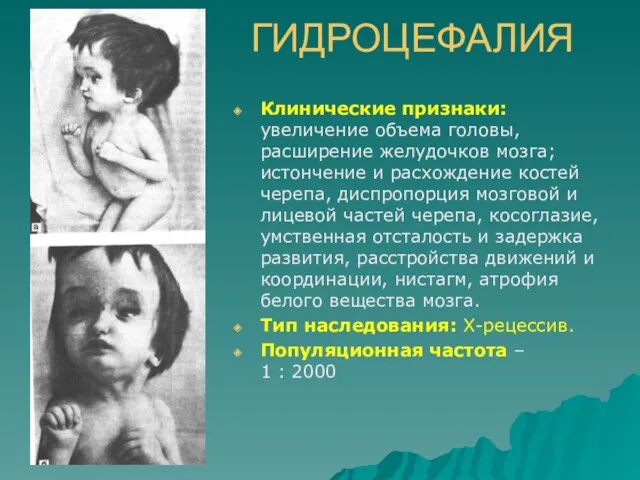 ГИДРОЦЕФАЛИЯ Клинические признаки: увеличение объема головы, расширение желудочков мозга; истончение