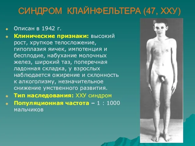 СИНДРОМ КЛАЙНФЕЛЬТЕРА (47, ХХУ) Описан в 1942 г. Клинические признаки: