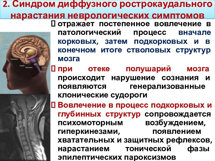 2. Синдром диффузного рострокаудального нарастания неврологических симптомов отражает постепенное вовлечение