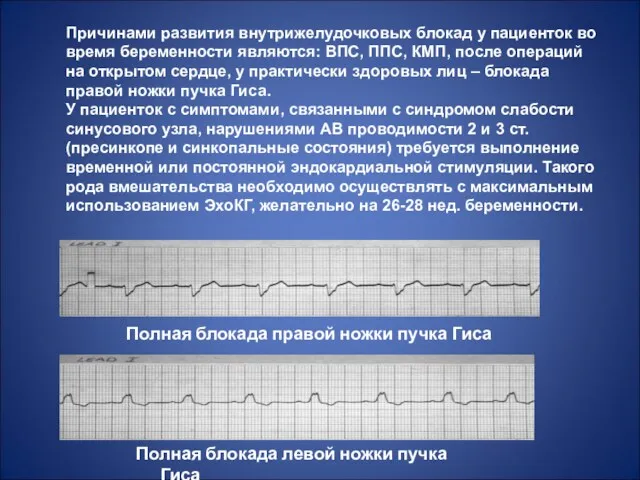 Причинами развития внутрижелудочковых блокад у пациенток во время беременности являются: