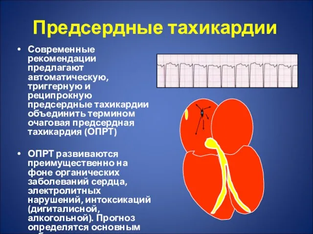 Предсердные тахикардии Современные рекомендации предлагают автоматическую, триггерную и реципрокную предсердные