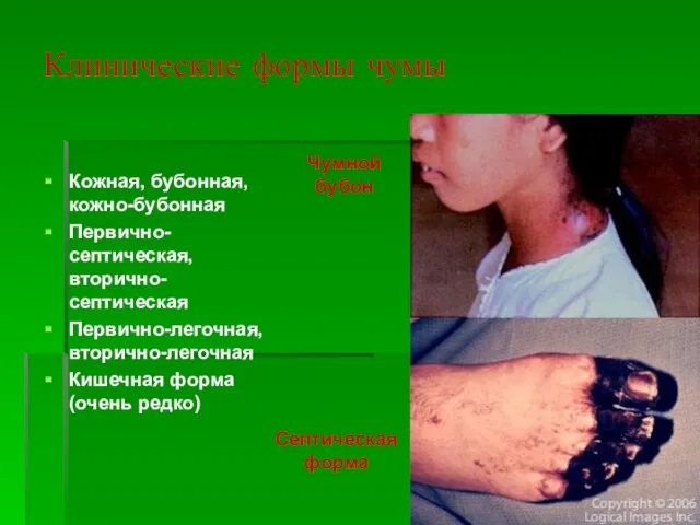 Клинические формы чумы Кожная, бубонная, кожно-бубонная Первично-септическая, вторично-септическая Первично-легочная, вторично-легочная