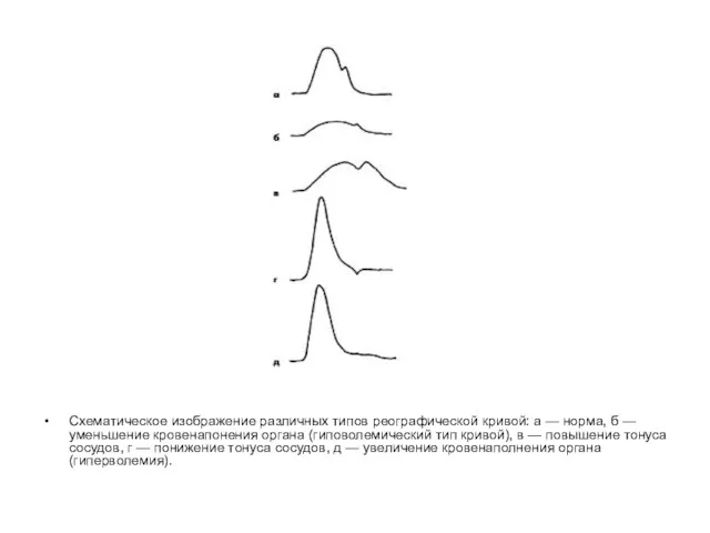 Схематическое изображение различных типов реографической кривой: а — норма, б