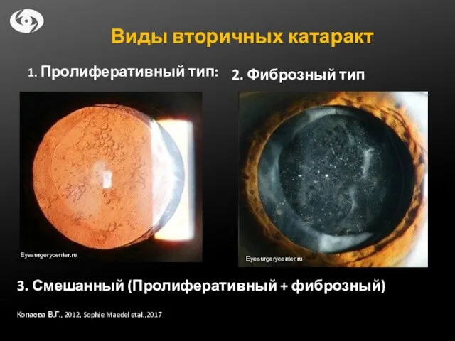 Виды вторичных катаракт 1. Пролиферативный тип: 2. Фиброзный тип 3. Смешанный (Пролиферативный +