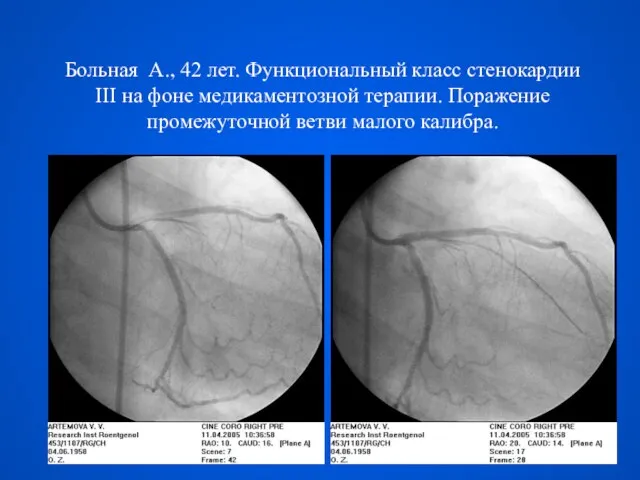 Больная А., 42 лет. Функциональный класс стенокардии III на фоне