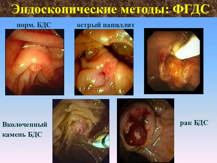 Эндоскопические методы: ФГДС норм. БДС острый папиллит рак БДС Вколоченный камень БДС