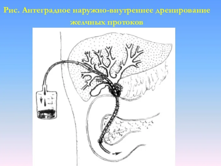 Рис. Антеградное наружно-внутреннее дренирование желчных протоков