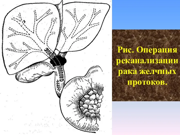 Рис. Операция реканализации рака желчных протоков.