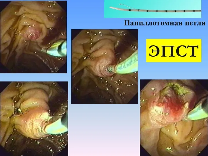 Папиллотомная петля ЭПСТ