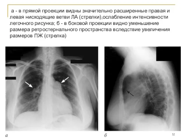 а - в прямой проекции видны значительно расширенные правая и левая нисходящие ветви