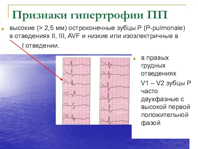 Признаки гипертрофии ПП в правых грудных отведениях V1 – V2