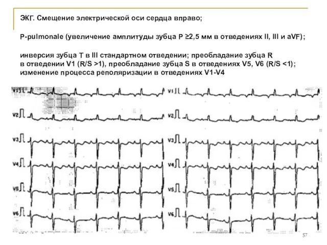 ЭКГ. Смещение электрической оси сердца вправо; P-pulmonale (увеличение амплитуды зубца Р ≥2,5 мм