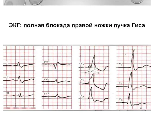 ЭКГ: полная блокада правой ножки пучка Гиса