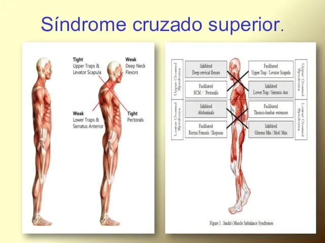 Síndrome cruzado superior.