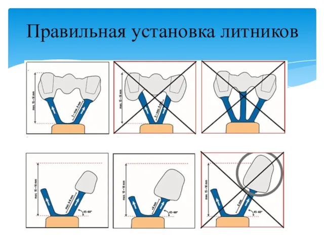 Правильная установка литников