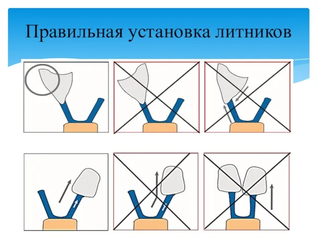 Правильная установка литников