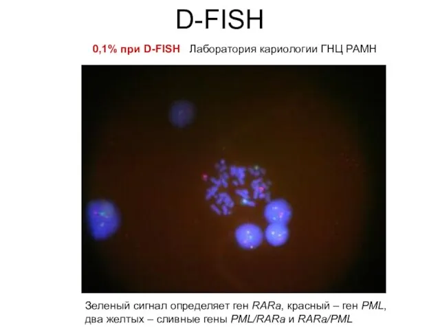 D-FISH 0,1% при D-FISH Лаборатория кариологии ГНЦ РАМН Зеленый сигнал определяет ген RARa,