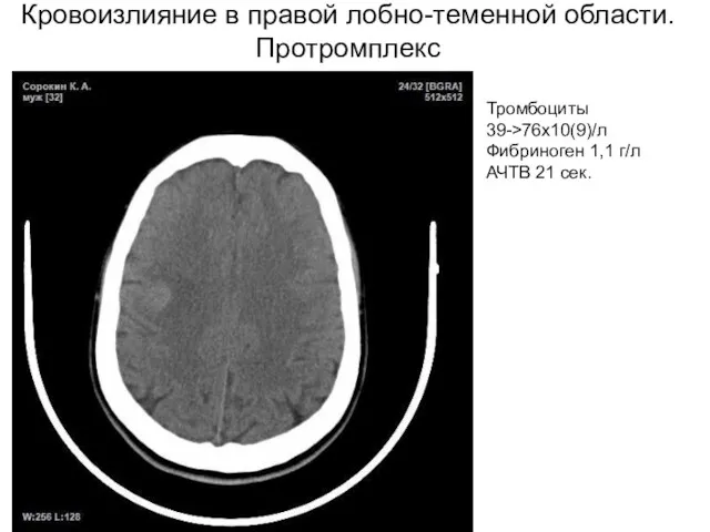 Кровоизлияние в правой лобно-теменной области. Протромплекс Тромбоциты 39->76х10(9)/л Фибриноген 1,1 г/л АЧТВ 21 сек.