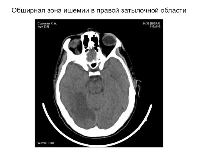 Обширная зона ишемии в правой затылочной области